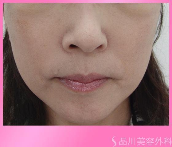 症例NO.3270のAFTER写真