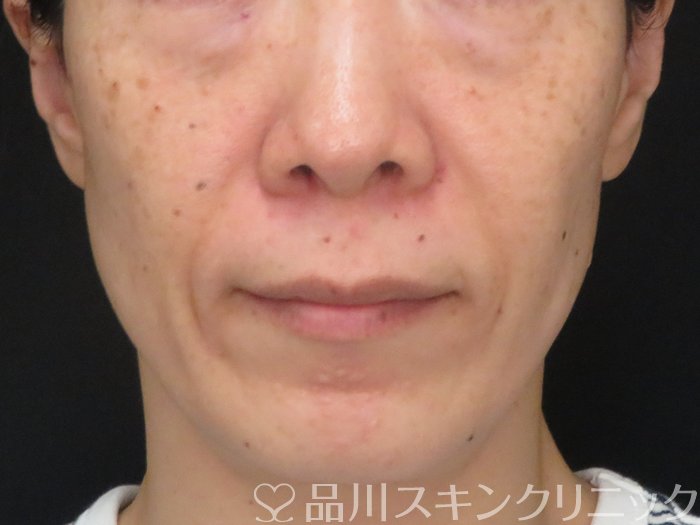 症例NO.69754のBEFORE写真