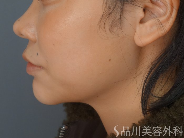 症例NO.73031のAFTER写真