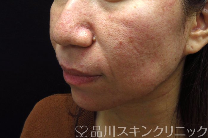 症例NO.74345のBEFORE写真