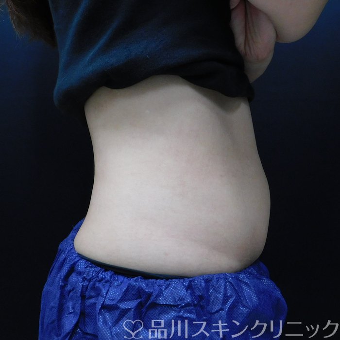 症例NO.65614のAFTER写真