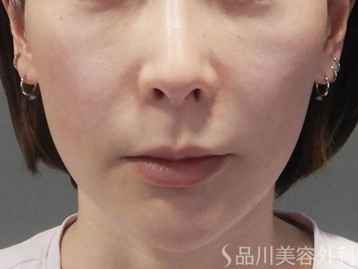 症例NO.70138のBEFORE写真