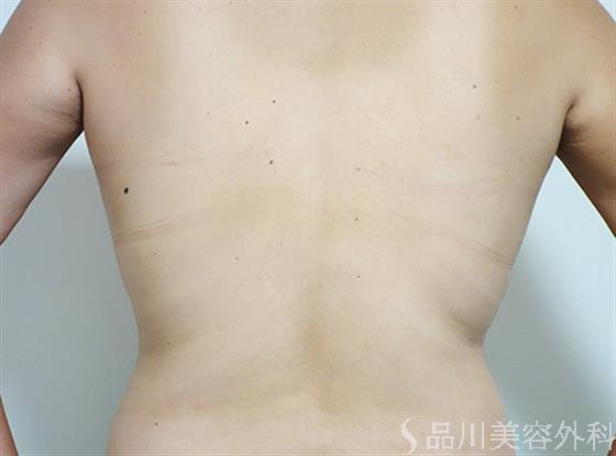 症例NO.24821のAFTER写真