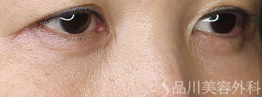 症例NO.73244のAFTER写真