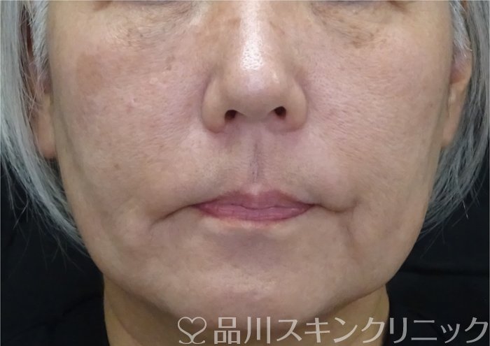 症例NO.69905のBEFORE写真
