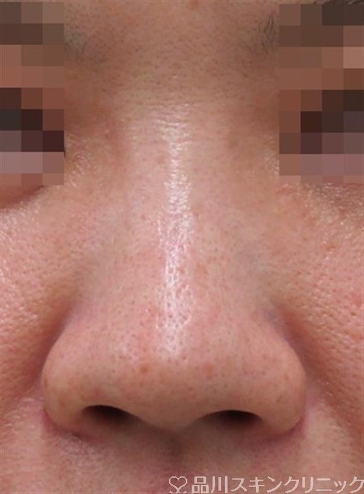 症例NO.34945のBEFORE写真