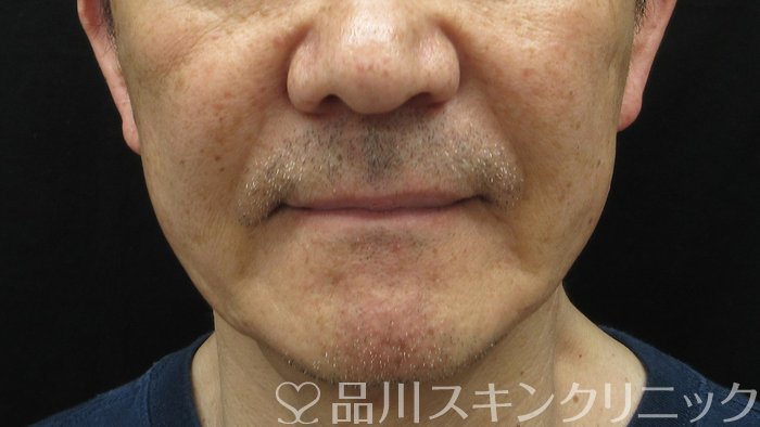 症例NO.69765のAFTER写真