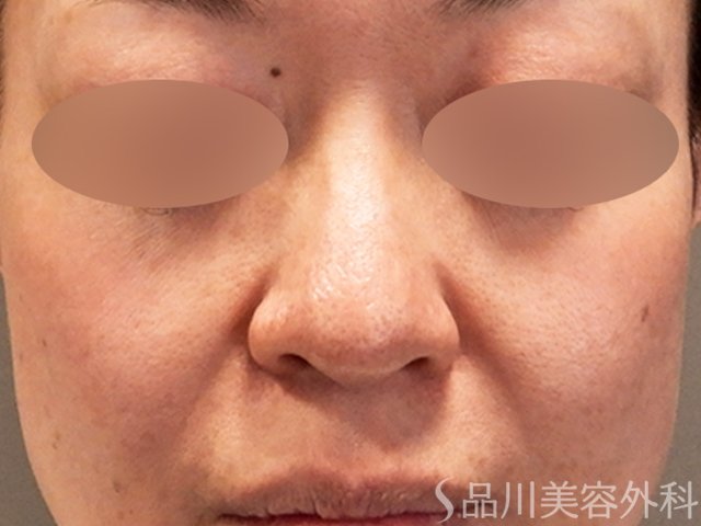 症例NO.69576のBEFORE写真