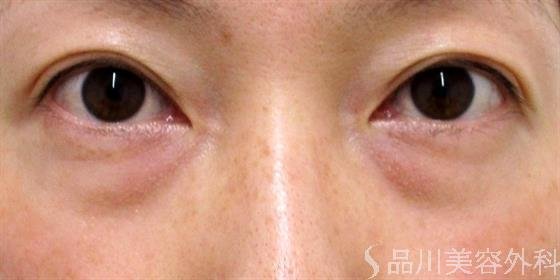 症例NO.59186のBEFORE写真