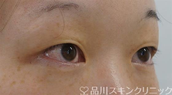 症例NO.52961のBEFORE写真