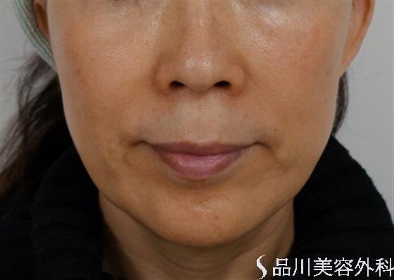 症例NO.35727のBEFORE写真