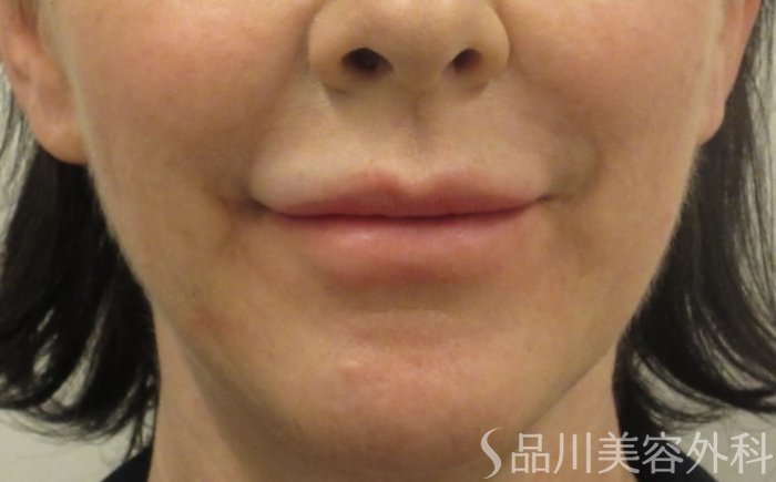 症例NO.72274のBEFORE写真