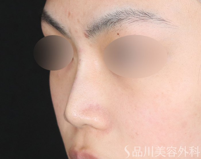 症例NO.72356のAFTER写真