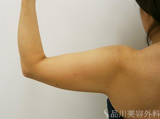 症例NO.25303のAFTER写真