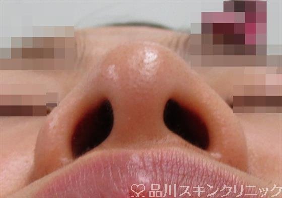 症例NO.34780のBEFORE写真