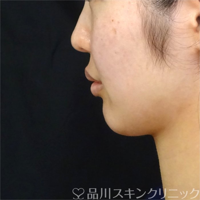 症例NO.71105のBEFORE写真