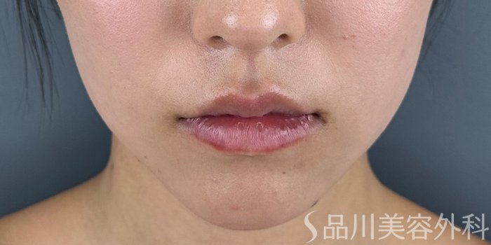 症例NO.70788のBEFORE写真