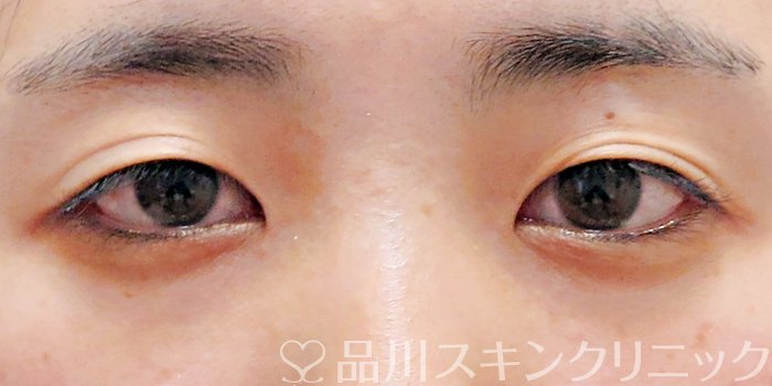 症例NO.69426のBEFORE写真