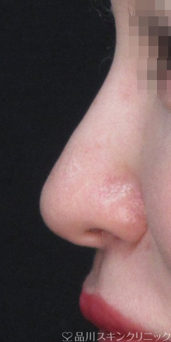 症例NO.72955のBEFORE写真