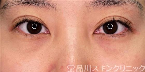 症例NO.57162のBEFORE写真