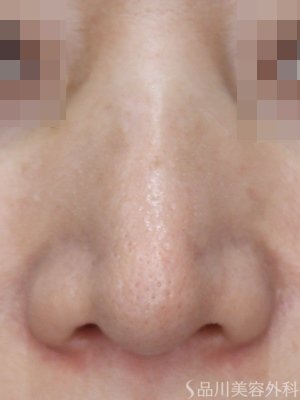 症例NO.75100のAFTER写真