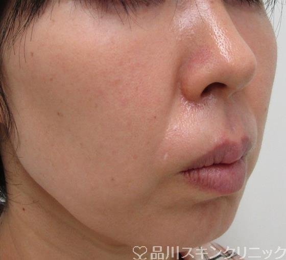 症例NO.30749のBEFORE写真