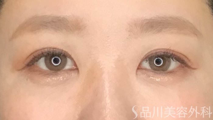 症例NO.65352のAFTER写真