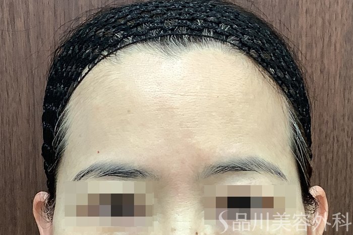 症例NO.67780のBEFORE写真