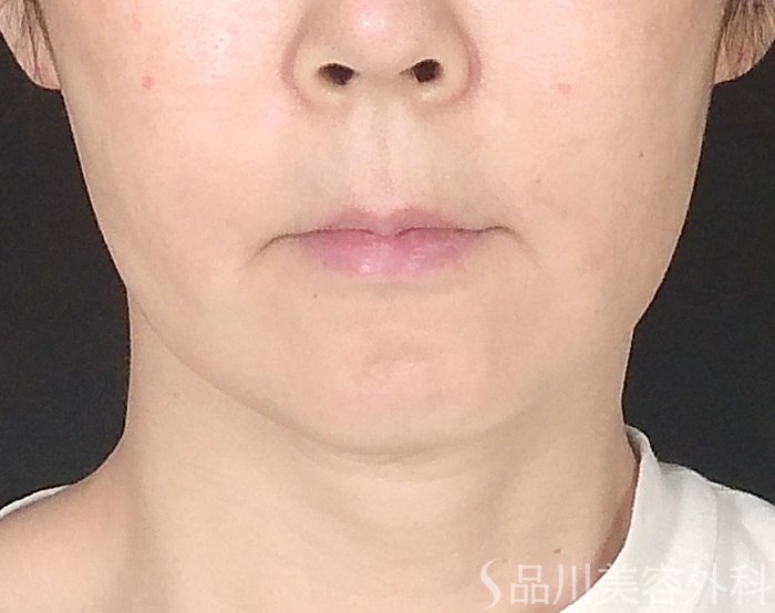 症例NO.65408のBEFORE写真