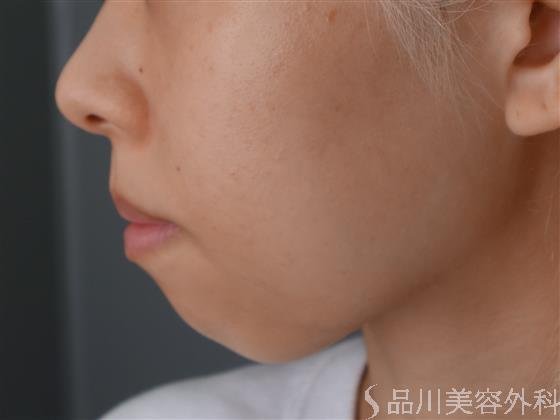 症例NO.52575のBEFORE写真