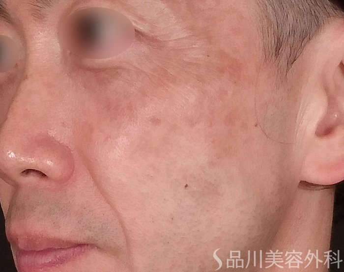 症例NO.70264のAFTER写真