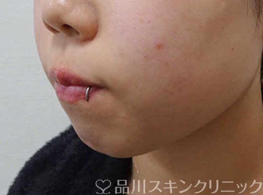 症例NO.64622のBEFORE写真