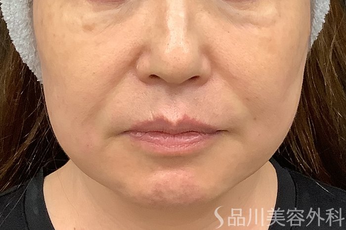 症例NO.71251のAFTER写真