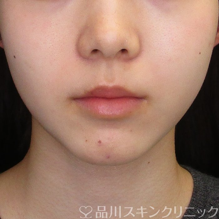 症例NO.73275のBEFORE写真