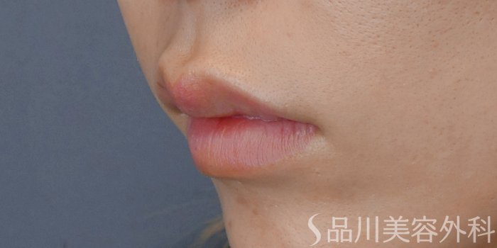 症例NO.72195のBEFORE写真