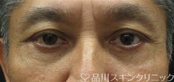 症例NO.61656のAFTER写真