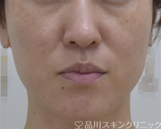 症例NO.53598のBEFORE写真