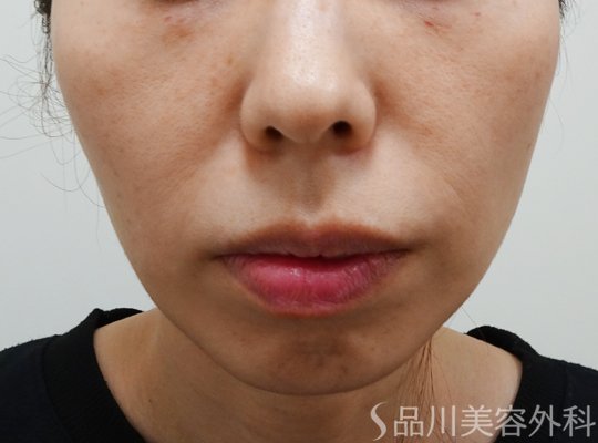 症例NO.73490のAFTER写真