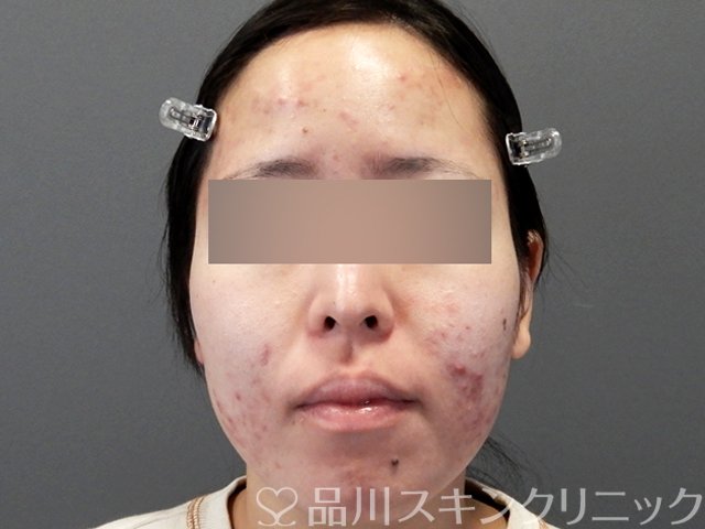 症例NO.71632のBEFORE写真