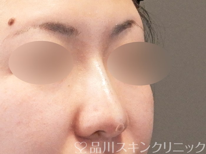 症例NO.64192のAFTER写真
