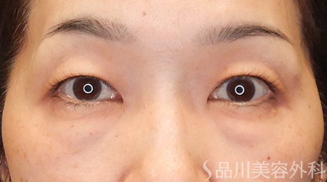 症例NO.75014のBEFORE写真