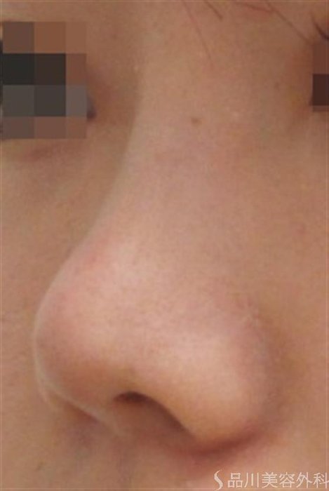 症例NO.22125のAFTER写真