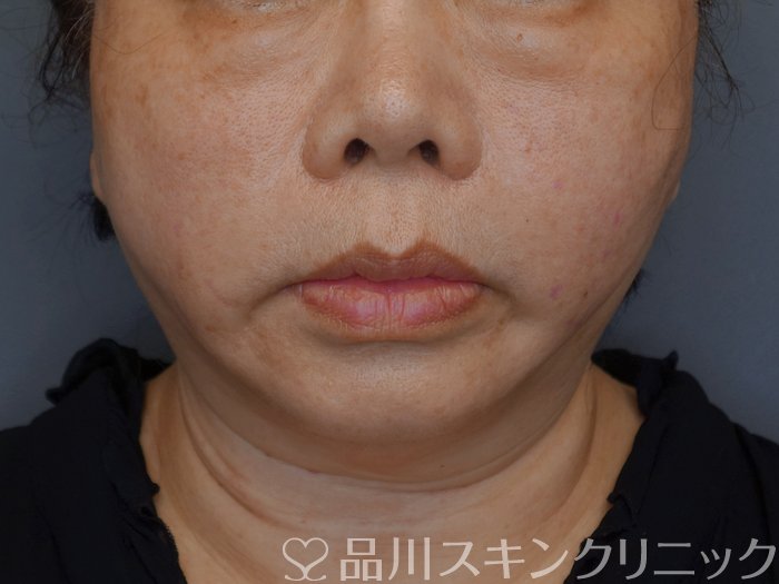 症例NO.74446のAFTER写真