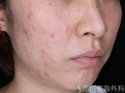 症例NO.69517のBEFORE写真