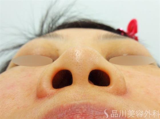 症例NO.25034のBEFORE写真