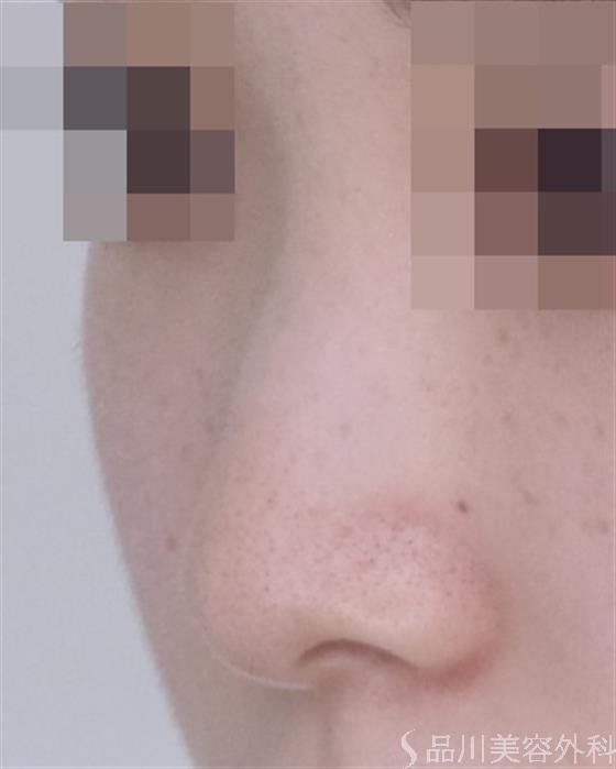 症例NO.49318のBEFORE写真
