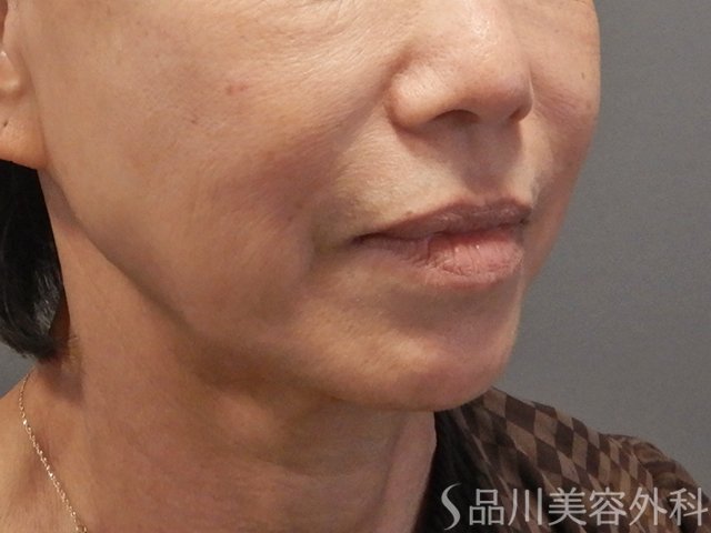 症例NO.72327のBEFORE写真