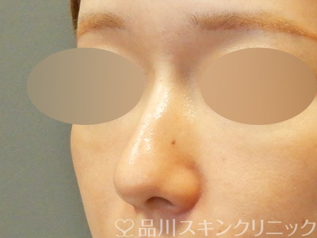 症例NO.67901のBEFORE写真