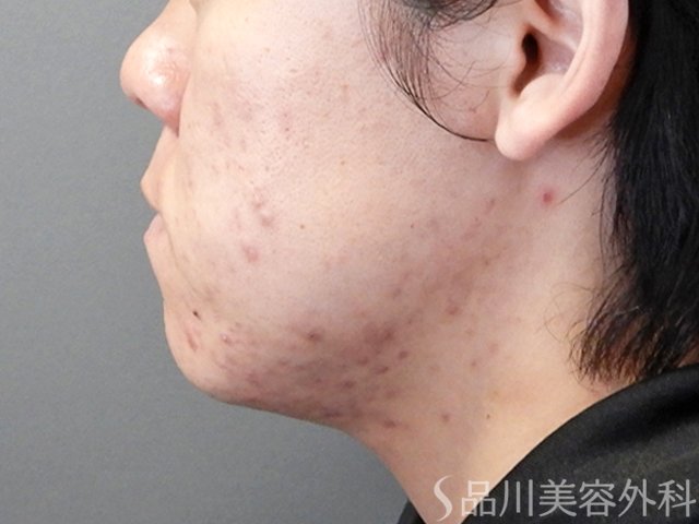 症例NO.69395のBEFORE写真