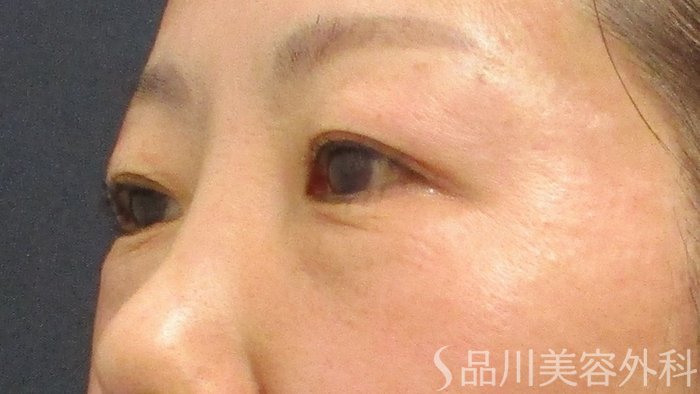 症例NO.69812のBEFORE写真